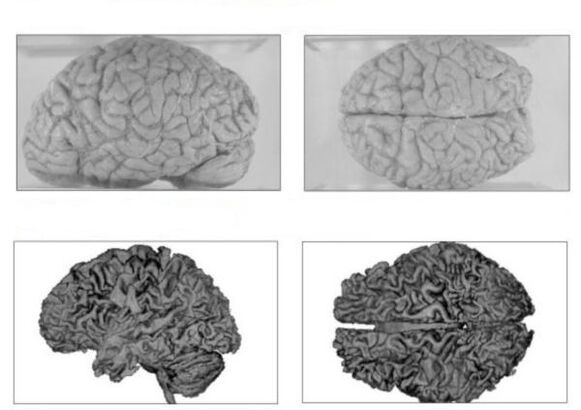 Terve inimese aju (ülemine) ja pöördumatute tagajärgedega alkohooliku aju (all)
